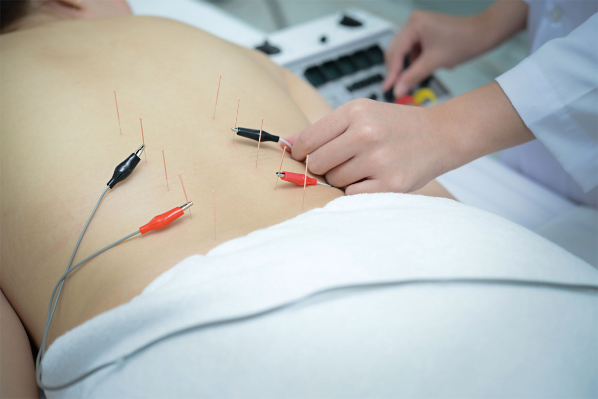 Electro Acupuncture - Traditional Chinese acupuncture and Electroa